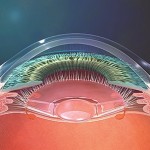 En vision de loin, l'optique de l'implant accommodatif crystalens reste en position postérieure dans le sac capsulaire