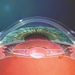 Une translation modérée vers l'avant de l'optique de l'implant accommodatif améliore la qualité de vision en distance intermédiaire.