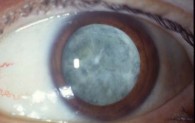 La cataracte : une pathologie d’avenir ?