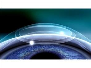 Le laser femtoseconde passe une seconde fois pour délimiter le lenticule cornéen.