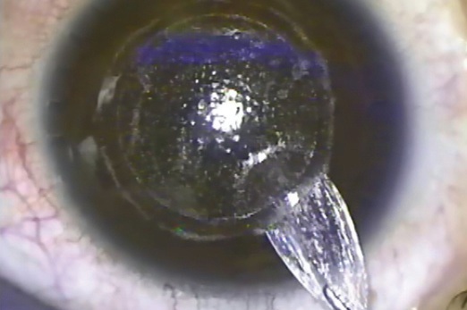 Après découpe des deux faces du lenticule cornéen, il ne reste plus qu'à l'extraire par une petite incision.