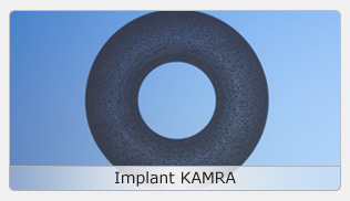 Aspect de l'inlay cornéen kamra utilisé en chirurgie de presbytie sur l'oeil non dominant
