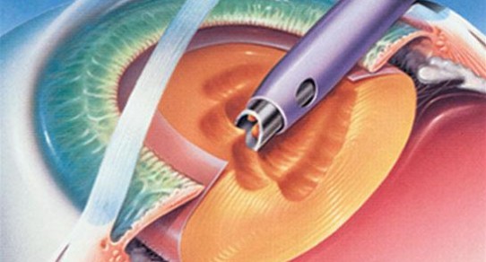 chirurgie-cataracte-phakoemulsification