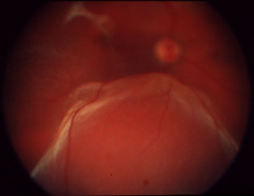 Décollement de rétine encore localisé en situation inférieure, avec visibilité du nerf optique au fond de l'oeil.