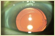 Astigmatisme et chirurgie de la cataracte