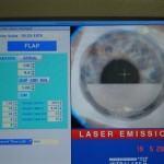 Le volet cornéen est en cours de réalisation au laser femtoseconde.