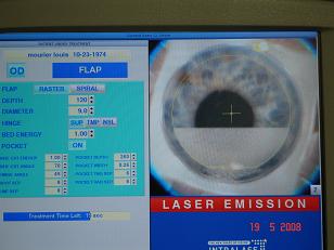 Le volet cornéen est en cours de réalisation au laser femtoseconde.