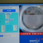 Le laser femtoseconde a déjà fait les deux tiers de la découpe cornéenne, dessinant le capot cornéen qui sera ensuite soulevé pour donner accès au laser excimer