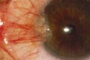 Pinguécula Et Ptérygion